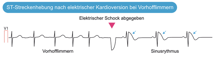 Abbildung 12. Elektrische Kardioversionen führen zu ST-Streckenhebungen.