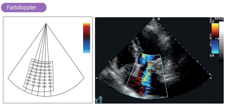 Abbildung 1. Das Bild links zeigt viele Sample Volumes innerhalb eines Doppler-Sektors. Das Bild rechts zeigt den Farbdoppler, der sich über der Mitralklappe und dem linken Vorhof befindet.