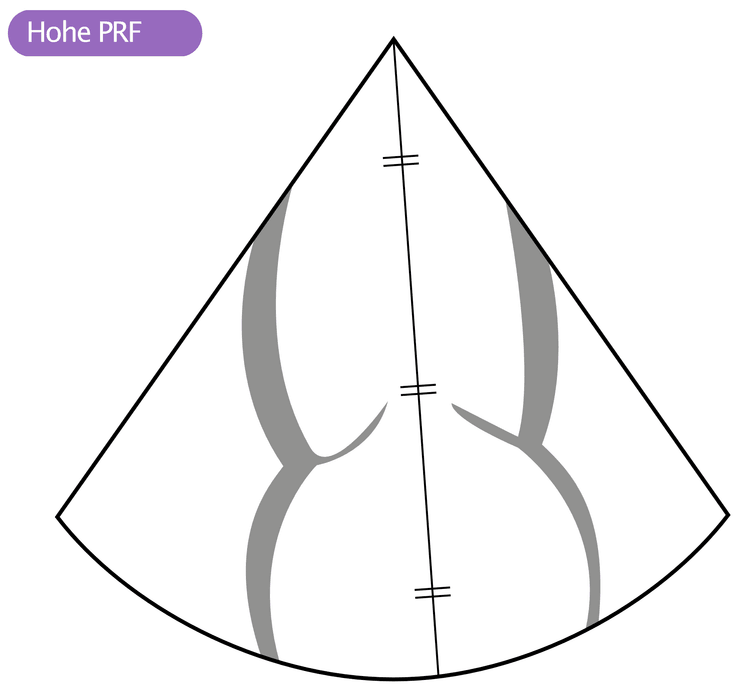 Abbildung 6. High-PRF-Doppler mit drei Sample Volumes, von denen sich zwei in Gebieten mit geringen Flussgeschwindigkeiten befinden.