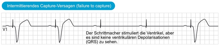 Abbildung 4. Intermittierendes Capture-Versagen (failure to capture).