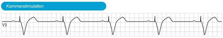 Abbildung 3. Die spontane atriale Aktivität wird von der Vorhofelektrode wahrgenommen und löst ventrikuläre Stimulationen aus. Der QRS-Komplex ist aufgrund der ventrikulären Depolarisation, die außerhalb des Reizleitungssystems verläuft, breit.