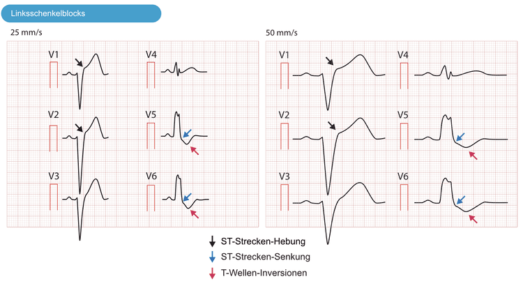 Abbildung 7. Der Linksschenkelblock (LBBB) verursacht auch sekundäre ST-T-Veränderungen, einschließlich einer ST-Hebung.