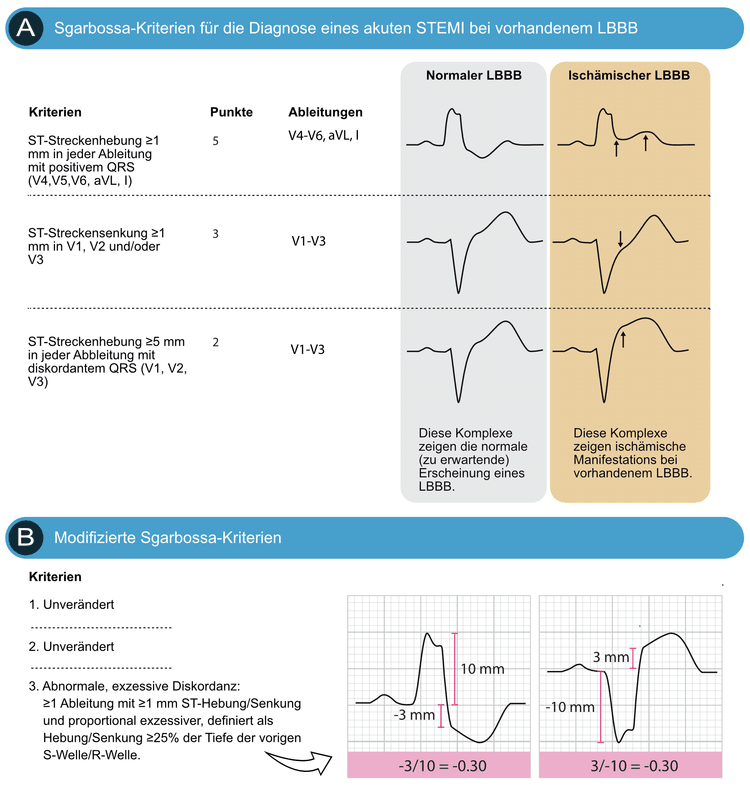 Abbildung 1. (A) EKG-Kriterien (Sgarbossa-Kriterien) für einen akuten ST-Hebungsinfarkt (STEMI) bei der vorhandenem LSB. Jedes Kriterium ergibt 2 bis 5 Punkte. Studien zeigen, dass ein Cut-Off von ≥3 Punkten eine Sensitivität von 20— 36% und eine Spezifität von 90— 98% für einen akuten ST-Hebungsinfarkt (STEMI) bei LSB ergibt. (B) Die Kriterien 1 und 2 der ursprünglichen Sgarbossa-Kriterien bleiben unverändert. Die R- oder S-Welle (je nachdem, welche am auffälligsten ist) und die ST-Strecke (relativ zur PQ-Strecke) werden auf die nächsten 0,5 mm gemessen. Das ST/S-Verhältnis wird für jede Ableitung berechnet, die diskordante ST-Abweichungen ≥1 mm aufweisen.