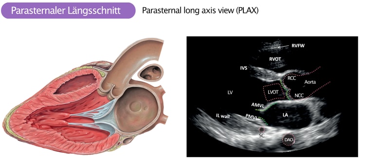 Abbildung 3. Parasternaler Längsschnitt. RVFW = Right ventricular free wall; RVOT = Right ventricular outflow tract; RCC = right coronary cusp; NCC = Non coronary cusp; LA = left atrium; LV = Left ventricle; IL wall = inferolateral wall; IVS = Interventricular septum (anterior aspect); AMVL = Anterior mitral valve leaflet; PMVL = Posterior mitral valve leaflet; DAO = Descending aorta.