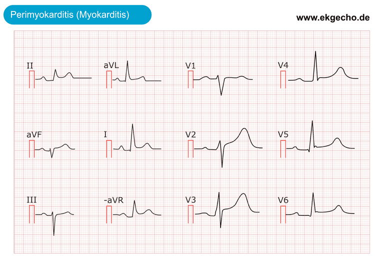 Abbildung 2. Das EKG bei akuter Perikarditis (Myokarditis, Perimyokarditis). Wie offensichtlich gibt es verallgemeinerte ST-Segmenthöhen. Es gibt keine reziproken ST-Segmenttiefungen und keine gleichzeitigen T-Wellen-Inversionen (negative T-Wellen).
