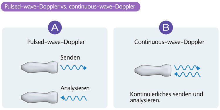 Abbildung 1. Der Unterschied zwischen pulsed-wave-Doppler und continuous-wave-Doppler (cw-Doppler). Der pulsed-wave-Doppler sendet kurze Ultraschallimpulse und analysiert reflektierte Schallwellen zwischen den Impulsen. Der continuous-wave-Doppler sendet und analysiert den Ultraschall kontinuierlich.