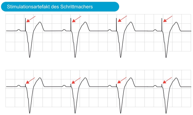 Abbildung 4. Das Stimulationsartefakt ist als ein Ausschlag (engl. spike) zu sehen, der dem QRS-Komplex vorausgeht. Dieses EKG zeigt eine normale P-Welle an, was darauf hinweist, dass eine Stimulation nur in den Ventrikeln erforderlich ist. Beachte, dass auf alle P-Wellen vom Schrittmacher ausgelöste ventrikuläre Kontraktionen folgen.