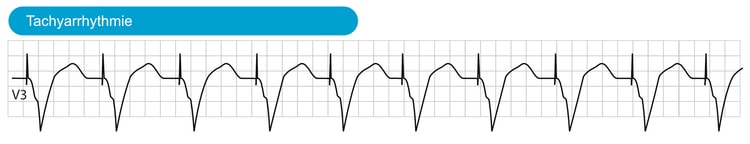 Abbildung 6. Tachyarrhythmie mit ventrikulärer Stimulation.