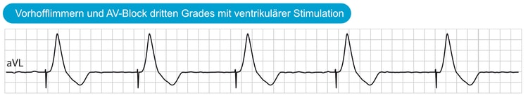 Abbildung 5. Vorhofflimmern und AV-Block dritten Grades mit ventrikulärer Stimulation.