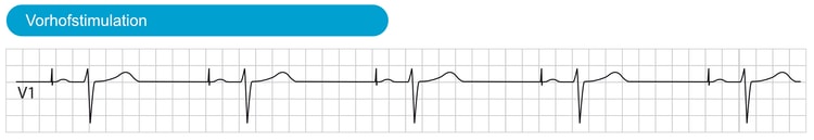 Abbildung 2. Atriale Stimulation mit normaler Leitung zu den Ventrikeln über das AV-System. Die Ventrikel werden über das His-Purkinje-Netzwerk depolarisiert, was zu einer normalen QRS-Dauer führt.