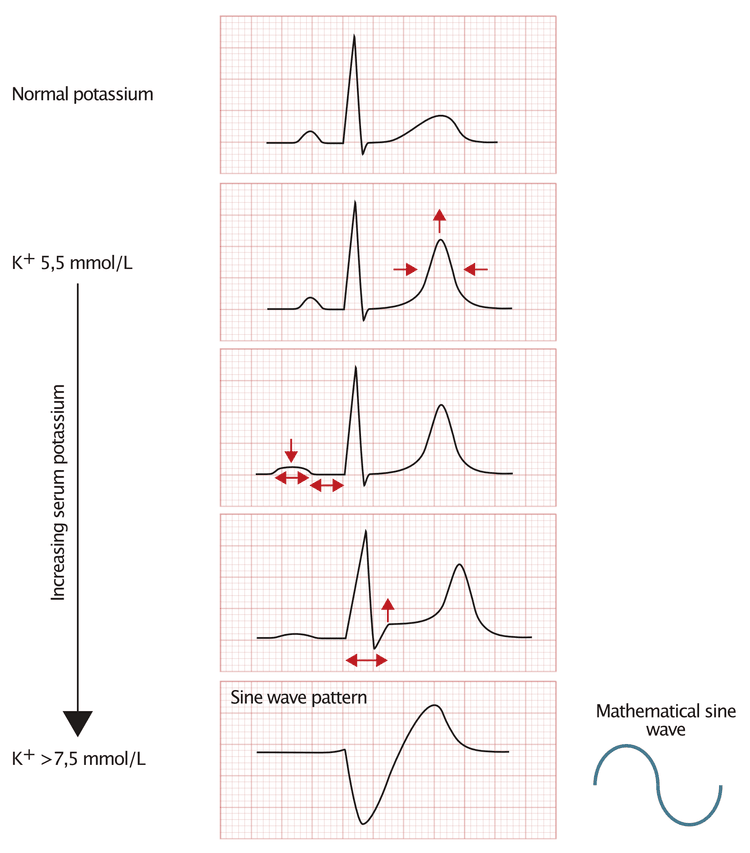 Abbildung 1. EKG-Veränderungen bei Hyperkaliämie.