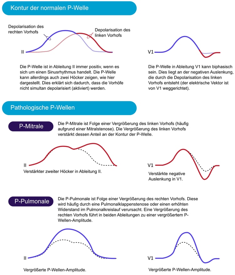 Abbildung 1. Die EKG-Kontur der normalen P-Wellen, des P mitrale (linksatriale Vergrößerung) und des P pulmonale (rechtsatriale Vergrößerung).