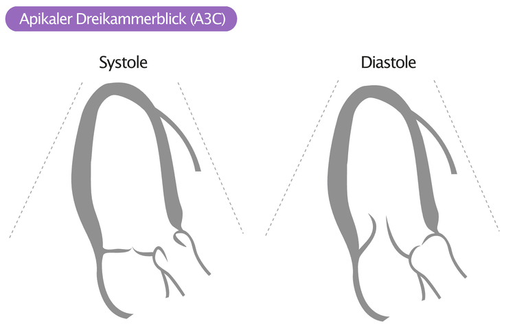 Abbildung 15: Apikaler Dreikammerblick (engl. apical three-chamber view, A3C).