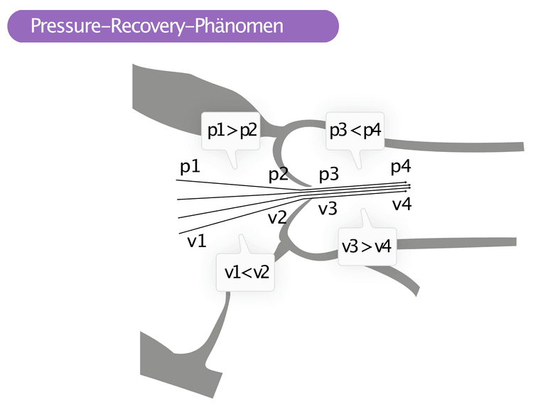 Abbildung 7. Pressure-Recovery-Phänomen. Der Druck fällt zwischen p1 und p2, steigt dann aber zwischen p3 und p4. Der in der Aorta mit kontinuierlichem Doppler gemessene Druck ist p3, welcher niedriger ist als p4. Der Druck in der Aorta ist also in Wirklichkeit höher als die Messung mit Doppler vermuten lässt.