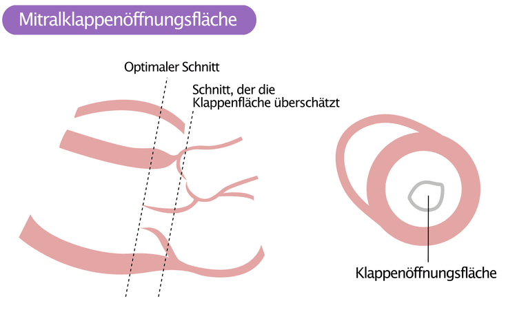 Abbildung 2. Mitralklappenöffnungsfläche.