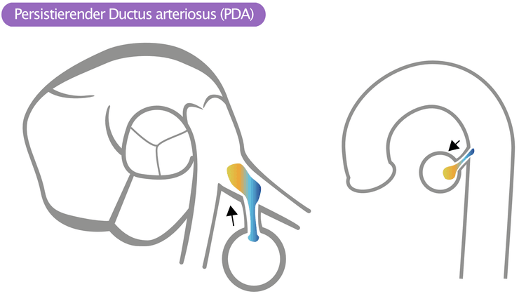 Abbildung 7. Persistierender Ductus arteriosus (PDA).