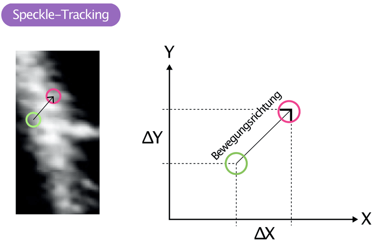 Figure 9. Speckle-Tracking.