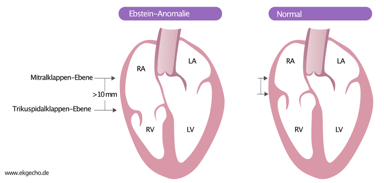 Abbildung 1. Ebstein-Anomalie