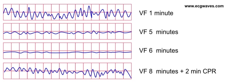 Natürlicher Verlauf von grobem Kammerflimmern (hohe Defibrillationserfolgswahrscheinlichkeit) zu feinem Kammerflimmern (niedrige Defibrillationserfolgswahrscheinlichkeit).