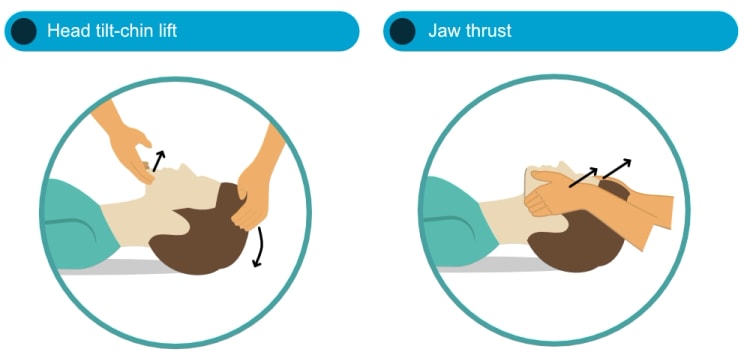 Methoden zum Öffnen des Atemwegs