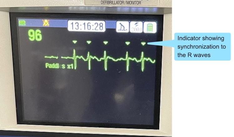 Pfeile zeigen die Synchronisation auf die R-Zacken
