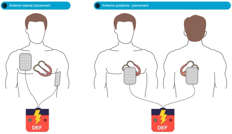 Position der Defibrillationselektroden bzw
