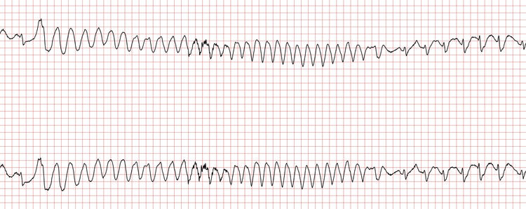 Das EKG zeigt die spontane Terminierung einer ventrikulären Tachykardie.