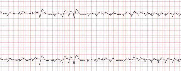 Das EKG zeigt einen einzelnen ventrikulären Schlag, gefolgt von einer Salve aus drei ventrikulären Schlägen (ventrikuläre Tachykardie).