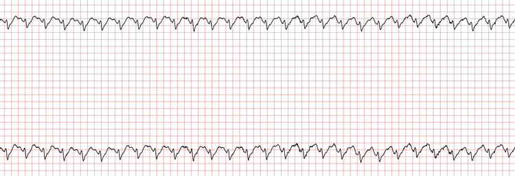 Das EKG zeigt einen regelmäßigen supraventrikulären Rhythmus, bei dem P-Wellen den QRS-Komplexen vorausgehen.
