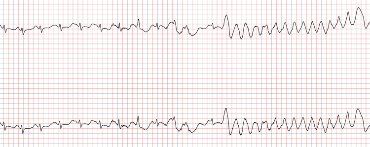 Das EKG zeigt einen Sinusrhythmus, der von einer ventrikulären Tachykardie unterbrochen wird.