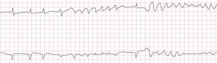 EKG 1 (Fall 1): Die ersten Schläge sind supraventrikuläre Schläge im Sinusrhythmus