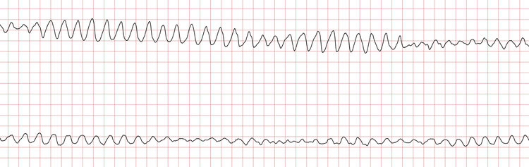 EKG 2 (Fall 1): Kammerflattern