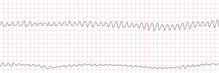 EKG 3 (Fall 1): Kammerflattern