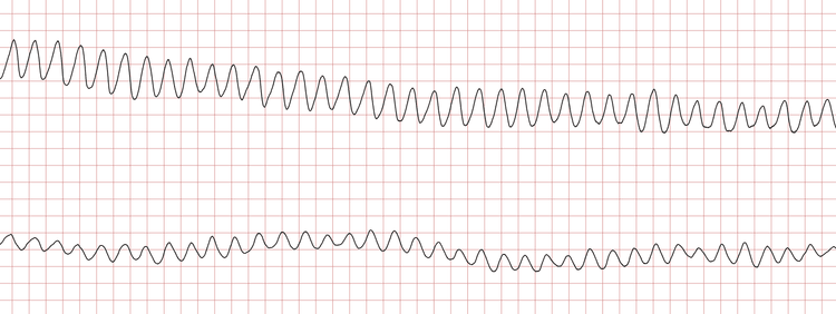 EKG 4 (Fall 1): Kammerflattern