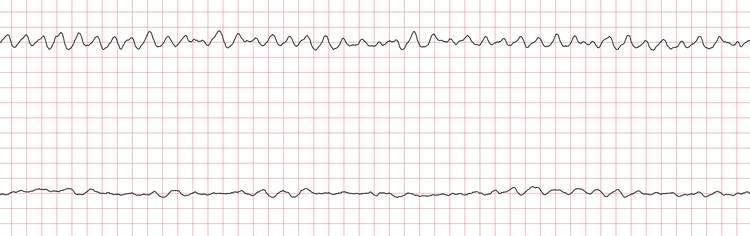 EKG 5 (Fall 1): Kammerflattern mit Übergang in Kammerflimmern
