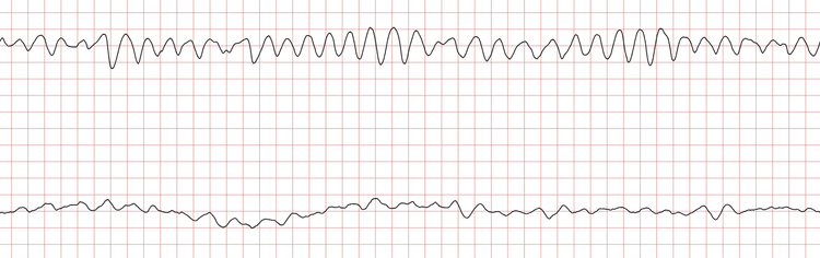 EKG 6 (Fall 1): Kammerflattern mit Übergang in Kammerflimmern