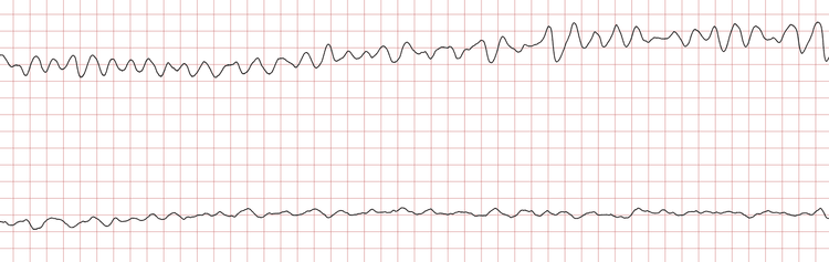 EKG 7 (Fall 1): Kammerflimmern