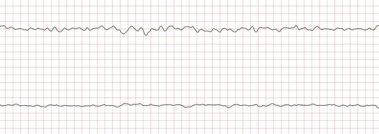EKG 8 (Fall 1): Kammerflimmern