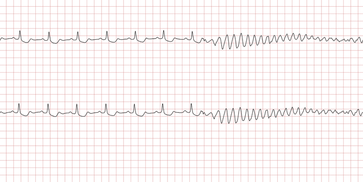 EKG 1 (Fall 2): Sinusrhythmus, unterbrochen durch eine schnelle ventrikuläre Tachykardie (VT)