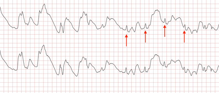 EKG 10 (Fall 2): Wiederkehr supraventrikulärer Komplexe (rote Pfeile)
