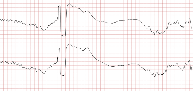 EKG 11 (Fall 2): Rezidiv von Kammerflimmern und erneuter Schock