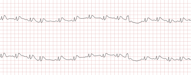 EKG 12 (Fall 2): Sinusrhythmus