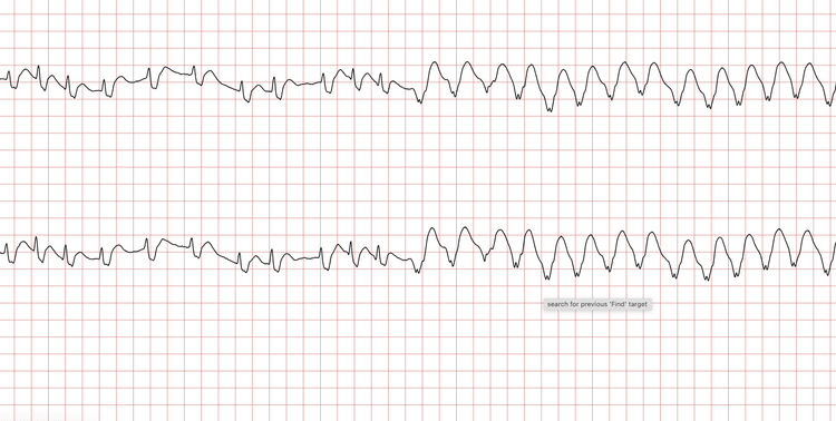 EKG 13 (Fall 2): Erneute VT