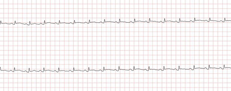 EKG 14 (Fall 2): Sinusrhythmus mit zuvor nicht vorhandenen ST-Hebungen