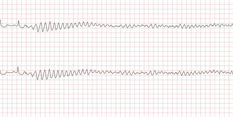 EKG 2 (Fall 2): VT mit Übergang in Kammerflimmern