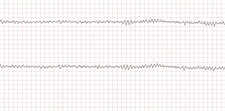 EKG 3 (Fall 2): Grobes Kammerflimmern (große Amplituden)