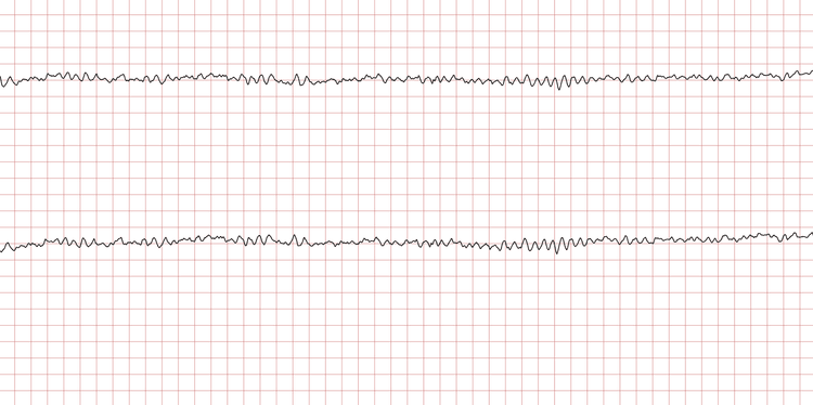EKG 4 (Fall 2): Kammerflimmern