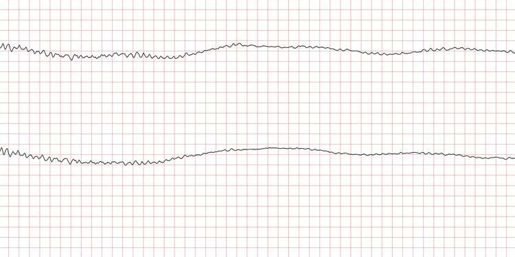 EKG 5 (Fall 2): Feines Kammerflimmern (niedrige Amplituden)