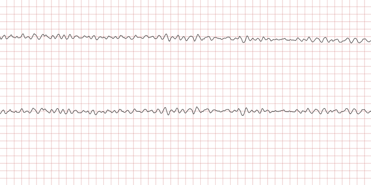 EKG 6 (Fall 2): Grobes Kammerflimmern