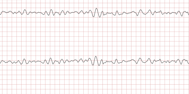 EKG 7 (Fall 2): Grobes Kammerflimmern